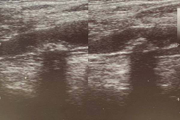 Ateroesclerosis.