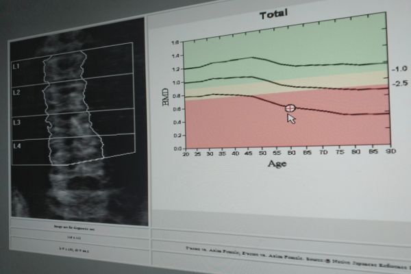 Osteoporosis.